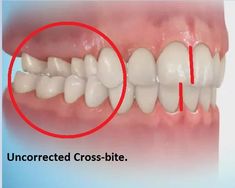 Crossbites are when your upper teeth are fitted inside your lower teeth. It’s not healthy and it can lead to bad enamel wear and tooth decay, or even jaw pain and headaches. They can be treated by palate expanders, braces, or for severe cases, surgery. Crossbite Teeth, Jaw Pain, Headache, Braces, Surgery