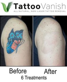 before and after photos of a tattoo removal