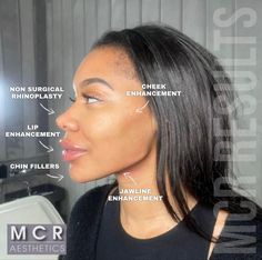 Nose Tip Filler, Nose Filler Before After, Lip Filler Black Women, Face Contouring Fillers, Face Balancing Fillers, Jawline Fillers Before And After, Facial Balancing Filler