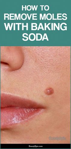 How To Remove Moles, Skin Tags On Face, Dark Mole, Remove Moles, Mole Removal