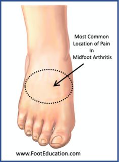 Midfoot arthritis is characterized by pain and swelling in the midfoot, aggravated by standing and walking. There is often an associated bony prominence on the top of the foot. Usually the symptoms develop gradually over time, although it can occur following a major midfoot injury, such as a Lisfranc injury. Non-operative treatme Thumb Pain Relief, Lisfranc Injury, Bag Of Ice, Arthritic Pain, Foot Pain Relief, Knee Exercises