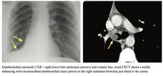 an x - ray shows the chest and ribs with yellow arrows pointing up at it