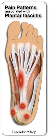 Plantar Fasciitis and Heel Spur Pain Mapping Hip Pain, Sciatica, Acupressure