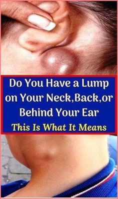 DO YOU HAVE A LUMP ON YOUR NECK - , BACK OR BEHIND YOUR EAR? HERE’S WHAT YOU NEED TO KNOW by vladimir mysa | This newsletter was created with Smore, an online tool for creating beautiful newsletters for educators, businesses and more Lump Behind Ear, Muscle Knots, Skin Bumps, Health Signs, Healthy Lifestyle Tips, Natural Home Remedies, Health Info, Home Health, Health Healthy