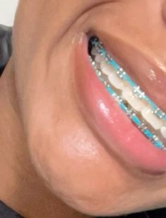 Such a pretty color, might get this again next time . Light Blue Power Chain Braces, Black Powerchain Braces Colors, Bright Blue Braces, Teal Braces Aesthetic, Braces Affirmations, Braces With Power Chains, Teal Power Chain Braces, Navy Blue Braces Teeth, Teal Braces On Black People