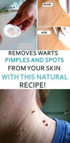 REMOVES WARTS, PIMPLES AND SPOTS FROM YOUR SKIN WITH THIS NATURAL RECIPE! What Causes Warts, Warts On Hands, Warts On Face, How To Remove Warts, Brown Spots On Skin, Remove Warts, Get Rid Of Warts, Brown Spots On Face, Spots On Face