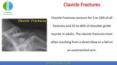 Clavicle Fractures account for 5 to 10% of all fractures and 35 to 40% of shoulder girdle injuries in adults. Medical Terminology Games, Shoulder Range Of Motion, Brachial Plexus, Sternocleidomastoid Muscle, Shoulder Girdle, Ligament Tear, Arteries And Veins, Latissimus Dorsi, Muscle Anatomy