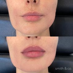 Russian Lips Filler Before And After, Bad Lip Filler, Russian Lip Filler Technique, Russian Lips Filler, Lip Fuller, Russian Lip Filler, Eye Lift Surgery, Facelift Makeup