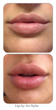 Botox Lips, Vampy Lips, Winter Lips, Lip Augmentation, 얼굴 드로잉, Facial Aesthetics, Lip Enhancement