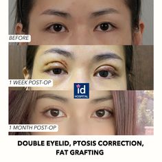 #idhospitalkorea #idhospital #idbeforeandafter #plasticsurgery #koreanplasticsurgery #plasticsurgerykorea #plasticsurgerybeforeandafter #cosmeticsurgery #upperblepharoplasty #doubleeyelidsurgery #fatgrafting #upperlidfatgrafting #ptosiscorrection #ptosisrepair Blephoraplasty Surgery