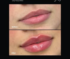 Lip Filler Russian, Lip Filler Inspo 1 Ml, 1ml Lip Filler, Lip Filler 1 Ml, .5ml Lip Filler, Kim Kardashian 2000's, 0.5 Ml Lip Filler Before And After, 1.5 Ml Lip Filler, Botox Lips