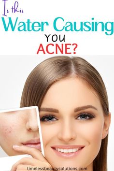 Best Red Hair Dye, Acne Reducing Foods, Dark Hair Dye, Microdermabrasion Machine, Acne Causes, Natural Healing Remedies, Acne Breakout, Prevent Acne, Positive And Negative