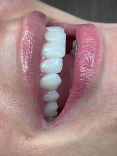 Grow Back Receding Gums, Whiten Teeth Fast, Teeth Whitening At Home, Pretty Teeth, Heal Cavities, Veneers Teeth, Teeth Whitening Diy, Beautiful Teeth, Whiten Your Teeth