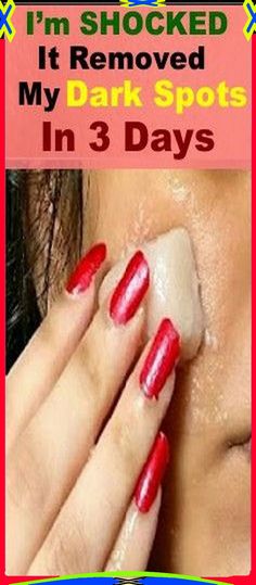 I�m SHOCKED It Removed My Dark Spots In 3 Days, Magic Remedy Natural Skin Lightening, Healthy Facts, Dark Spots On Face, Brown Spots On Face, Dark Spots On Skin, Spots On Face, Glow Skin, Remove Dark Spots, Utila