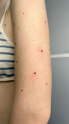 a woman's arm with black spots on it and her left arm is showing