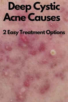 If you are suffering from deep cystic acne, there may not be a lot that can be done about it that won't involve invasive procedures or chemicals. However, there are a few things that you can do to minimize the appearance and severity of your acne Treating Cystic Acne, Acne Diet, Natural Acne Remedies, Acne Causes, Under The Surface, Cystic Acne, Fitness Advice, Hair Care Tips