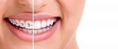 Common Reasons Your Peoria Braces are Falling off! Dental Braces, Teeth Straightening, Teeth Braces, Emergency Dentist, Natural Teeth Whitening, Dental Surgery, Dental Problems, Dental Services