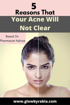 Skincare Routine Acne, Best Acne Cleanser, Bad Acne, Acne Skincare, Acne Treatments