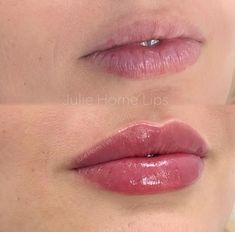 Lip Fillers, Lips, Quick Saves, Beauty