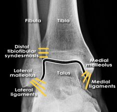 an x - ray shows the location of fibrosis in the knee