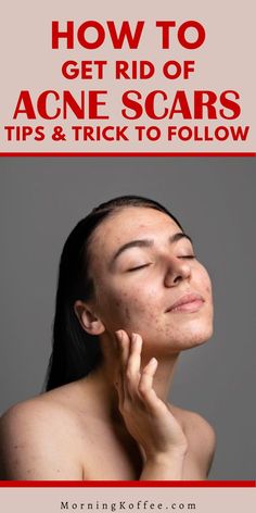 tHere are many various ways how you can reduce acne scars apeaarnece. And here are the treatment fr acne sacrs to get rid of it or reduce the appearence from home treatment to clinical treatments and also we gtahered ways to get rid of acne scars naturally as an akternative to help you reduce your acne scar appearence, Best home remedies to get rid of acne scars. Scar Remedies, Remedies For Acne, Get Rid Of Acne, Rid Of Acne, Acne Scar, Home Remedies For Acne, Reduce Acne, Best Skincare Products, Fade Dark Spots