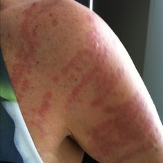 the back of a woman's arm with red spots on it