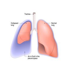 Home Remedies For Bronchitis, Chest Tube, Pleural Effusion, Healthy Lungs, Increase Heart Rate, Breathing Problems, Heart Function, Pulmonary Disease, Lung Disease