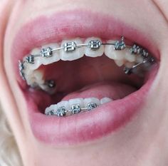 Metal Braces Aesthetic, Braces Reference, Gray Braces, Orthodontics Teeth, Guys With Braces, Getting Braces