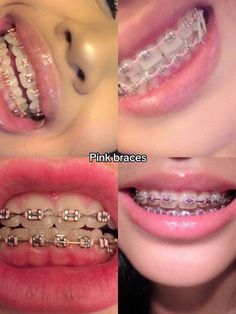 Pink Braces Aesthetic, Braces Designs, Cute Braces Colors Aesthetic, Aesthetic Braces, Braces Aesthetic