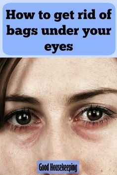 How to get rid of bags under your eyes. If you’ve ever experienced shadowy dark circles under your eyes, you’ll know how annoying they are. #health #skincare #eyecare Tips For Dark Circles, Bumps Under Eyes, Eye Care Tips, Dark Spots Remedies, Dark Circle Remedies, Korean Beauty Tips, Remove Dark Circles