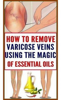 How to remove varicose veins  - using magic olive oil by Blage Tristian | This newsletter was created with Smore, an online tool for creating beautiful newsletters for educators, businesses and more How To Flatten Stomach, Varicose Vein Removal, Color Knowledge, Quick Workout Routine, Workout Without Gym, Abdominal Fat, At Home Workout Plan, Natural Hair Growth, Quick Workout