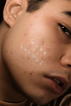 Different Types Of Acne, Real Bodies, Glow Skin, Body Love, Perfectly Imperfect, Skin Conditions