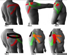 Good kinesiotaping website that is diagnosis specific Y Strap Chiropractic, Kinesio Tape, Tape Shoulder, Kt Tape, Kinesio Taping, Frozen Shoulder, Frosé, Kinesiology Taping