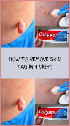 How to Remove Skin Tag by Nina Bliznakovska | This newsletter was created with Smore, an online tool for creating beautiful newsletters for educators, nonprofits, businesses and more Cough Remedies, 1st Night