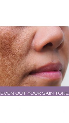 Online Skincare Clinic! Get virtual skincare consults from the comfort of your home using a virtual aesthetician with experience working in spas, plastic surgery offices, and cosmetics. Hyperpigmentation Remedies, Hyperpigmentation Black Skin, Glymed Plus, Hyperpigmentation Serum, Skin Care Hyperpigmentation, Skincare Clinic, Dark Spots On Face, Skin Hyperpigmentation, Sun Damaged Skin