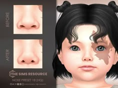 an image of a child's nose before and after it has been rhinoceros removed