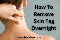 People don't remove skin tags only for cosmetic or aesthetic reasons. If you develop skin tags regularly and on multiple parts of the body, Castor Oil For Skin, Healthy Book, Home Remedies For Skin, Skin Moles, Mole Removal