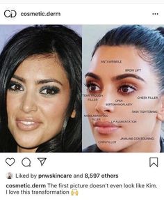 Celebrity Surgery, Cosmetic Fillers, Cheek Fillers, Facial Contouring, Celebrity Plastic Surgery, Brow Lift