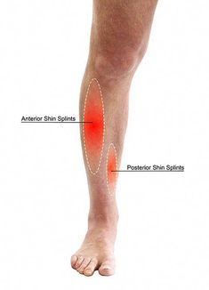 An article on what causes shin splints, how to fix shin splints, and the symptoms of shin splints. Chin Splints Remedy, Anterior Shin Splints, Shin Splints Stretches, Leg Cramps At Night, Lower Leg Muscles, Calf Cramps, Swollen Knee, Kinesiology Taping