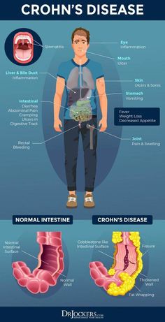 Chrons Disease, How To Remove Warts, Inflammatory Bowel, The Digestive System, Disease Symptoms, Medical Dental, Oral Care Routine, Oral Health Care, Keeping Healthy