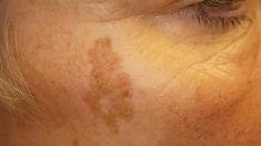 Should you be nervous about your sunspots? We’ll explain the differences between true sunspots and other skin lesions. We’ll also explore treatment options for sunspots and explain when you should see a doctor. A sunspot is never cancerous and almost never has the ability to become cancerous. Age Spots On Face How To Get Rid Of, How To Get Rid Of Age Spots, Removing Age Spots On Face, How To Remove Age Spots, How To Remove Brown Age Spots, How To Get Rid Of Age Spots On Face, How To Remove Age Spots On Face, Liver Skin Spots, Age Spots How To Get Rid Of