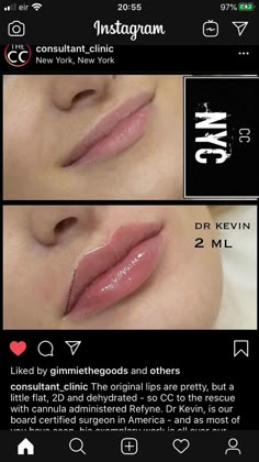 Downturned Lips Filler, 1 Ml Lip Filler Before And After, Lips With Filler