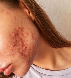 #acne #acnetreatment #acneproneskin #cysticacne #accutane#clearskin #acnefree Facials For Acne, Acne On Back, What Causes Acne, Clear Up Acne, Diy Facials, Back Acne, Art Final, Diy Acne, Acne Solutions