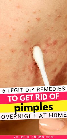 Pimples might be a nuisance, but with these DIY remedies, you can tackle them head-on! Remember, everyone’s skin is different, so find what works best for you. Get Rid Of Pimples Overnight, Rid Of Pimples Overnight, Rid Of Acne Overnight, Get Rid Of Acne Overnight, Back Acne Remedies