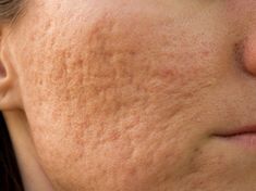 3 Ways to Finally Get Rid of Pockmarks and Acne Scars Scar Remedies, Bad Acne, Natural Acne Remedies, Home Remedies For Acne, Types Of Acne, Acne Scar Removal, Scar Removal, Cystic Acne, Acne Remedies