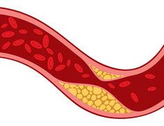 One of the most common forms of heart disease is CAD (Coronary Artery Disease) which is a build up of LDL "bad" cholesterol in the arteries. This can lead to a heart attack. Prevent CAD with a healthy diet of fruits and vegetables as well as plenty of exercise. lifepilllaboratories.com. #TheLifePill #DrAlfredSparman #PreventativeCare #CAD #CoronaryArteryDisease #BadCholesterol #LDL #HeartAttack #Risks #HeartHealth #HealthyLiving #HealthyLifestyle #HerbalHeartHealth Ways To Lower Cholesterol, What Is Cholesterol, Lowering Ldl, Bad Cholesterol, High Cholesterol Levels, The Dating Divas, Coronary Arteries, Ldl Cholesterol, Heart Problems