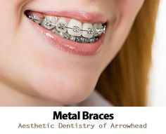 Are you thinking about straightening your teeth? Learn about the different types of braces in Glendale including metal & ceramic #braces, #Invisalign and #ClearCorrect! http://www.drgregceyhan.com/braces/what-different-types-glendale-braces-unique-advantages Clear Braces Vs Metal, Overjet Overbite, Overbite Braces, Ceramic Braces, Invisible Braces, Clear Braces