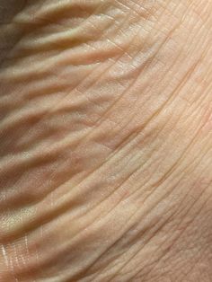 the skin on someone's hand is white and light brown, with small ridges in it