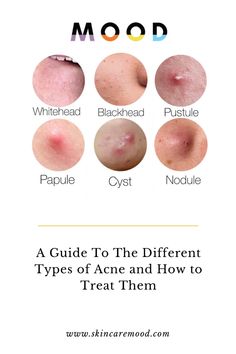 Acne Awareness, Nodule Acne, Cystic Acne Remedies, Different Types Of Acne, Forehead Acne, Pimples Under The Skin, Bad Acne, Acne Overnight, Natural Acne Remedies