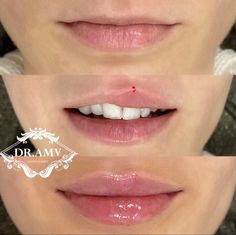 Lip Filler For Uneven Lips, One Syringe Lip Filler, Lip Filler Small Mouth, Lip Filler Inspiration Small Lips, Natural Lip Fillers 0.5ml, Lip Filler On Small Lips, Armonizacion Facial, Lip Filler Before And After